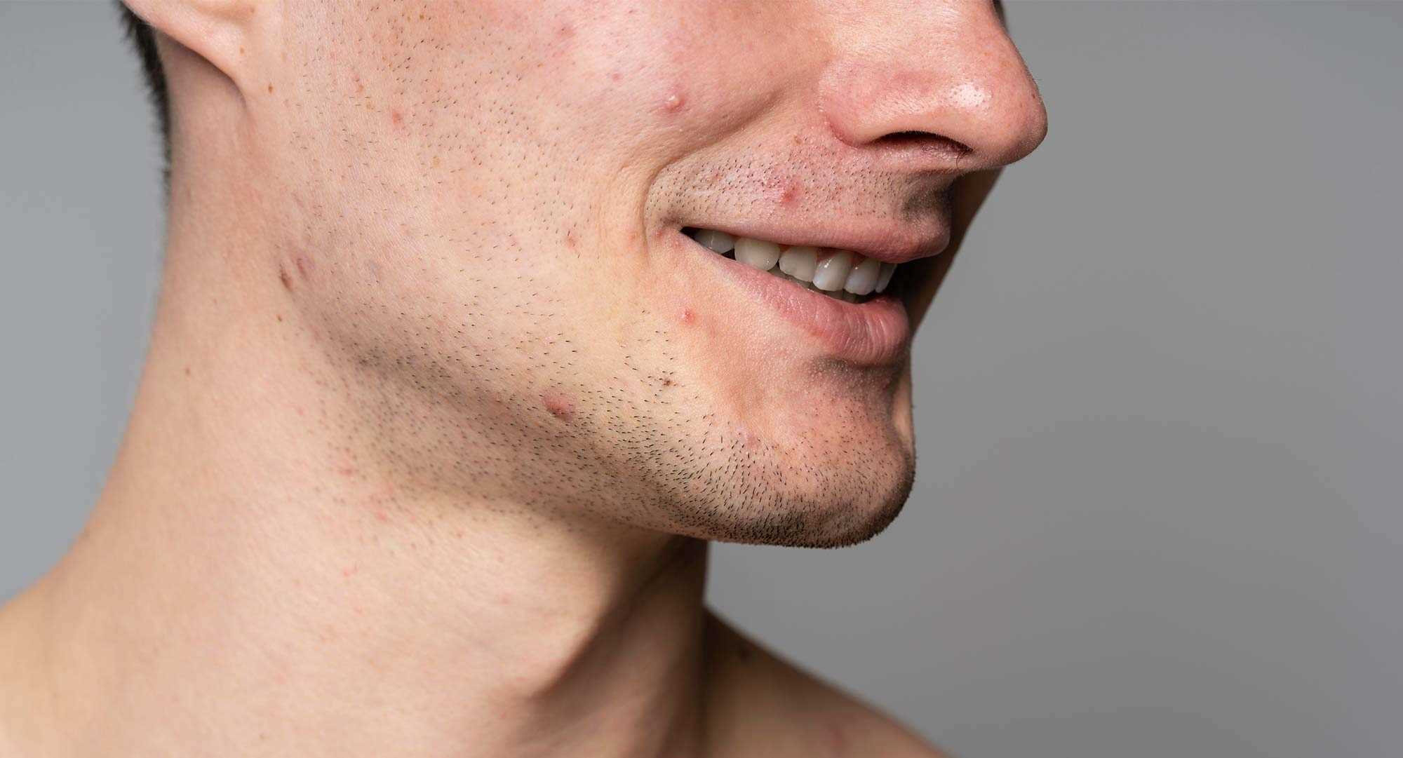 دلایل شایع جوش و آکنه