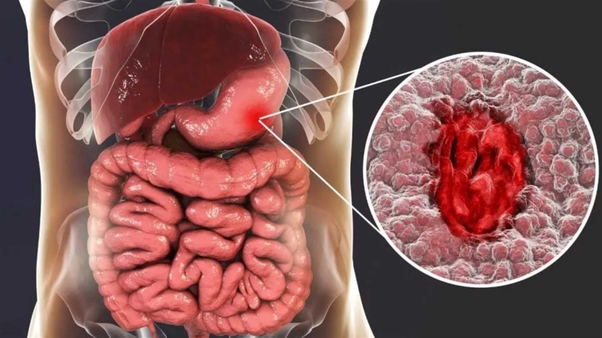 عمل زخم معده