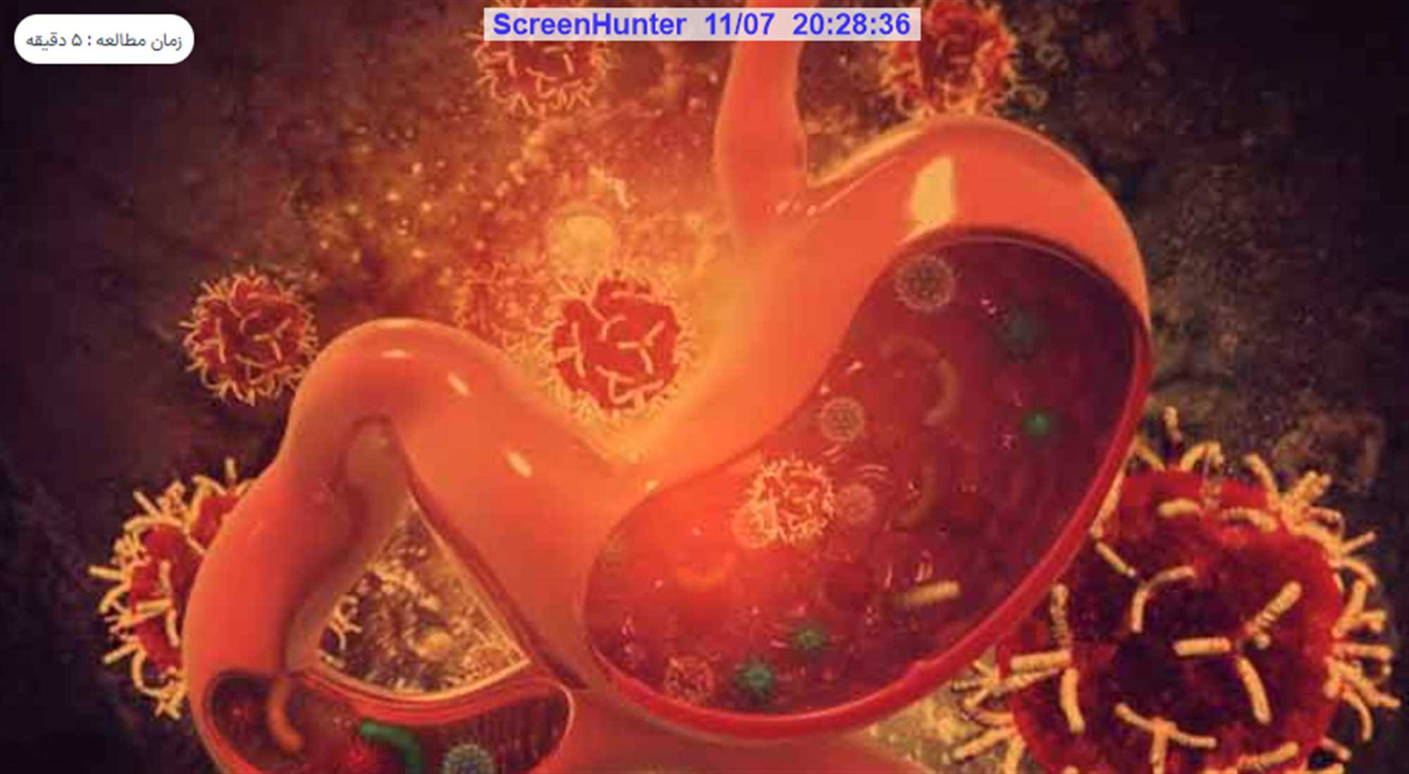 سرطان معده بدخیم