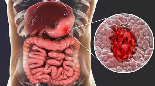 عمل زخم معده